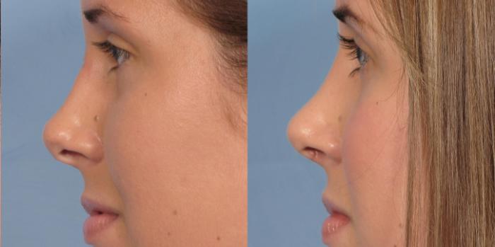 Before & After Rhinoplasty (Nose Reshaping) Case 91 View #5 View in Naples and Ft. Myers, FL