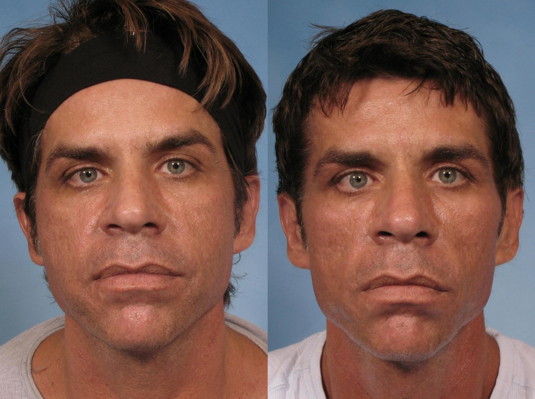 Sculptra Before And After Pictures Case 125 Naples And Ft Myers FL 