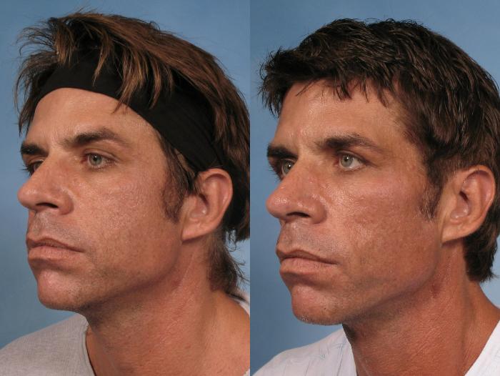 Before & After Sculptra® Case 125 View #2 View in Naples and Ft. Myers, FL