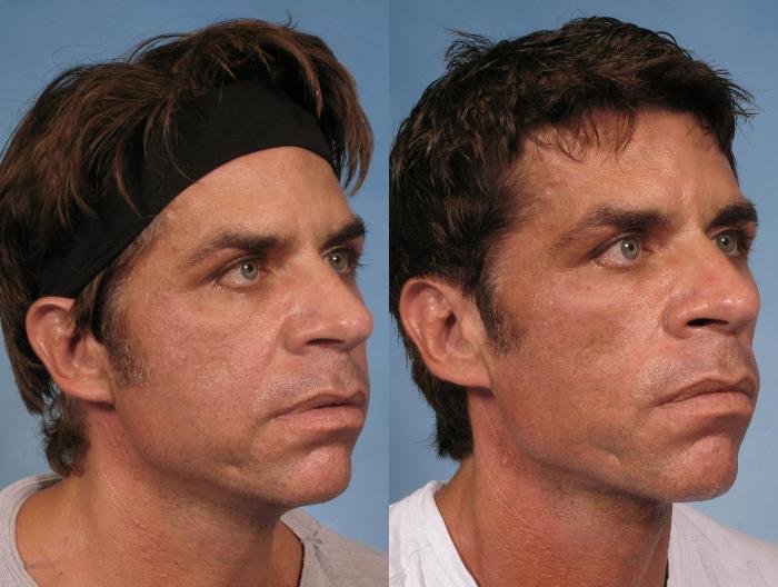 Before & After Sculptra® Case 125 View #3 View in Naples and Ft. Myers, FL