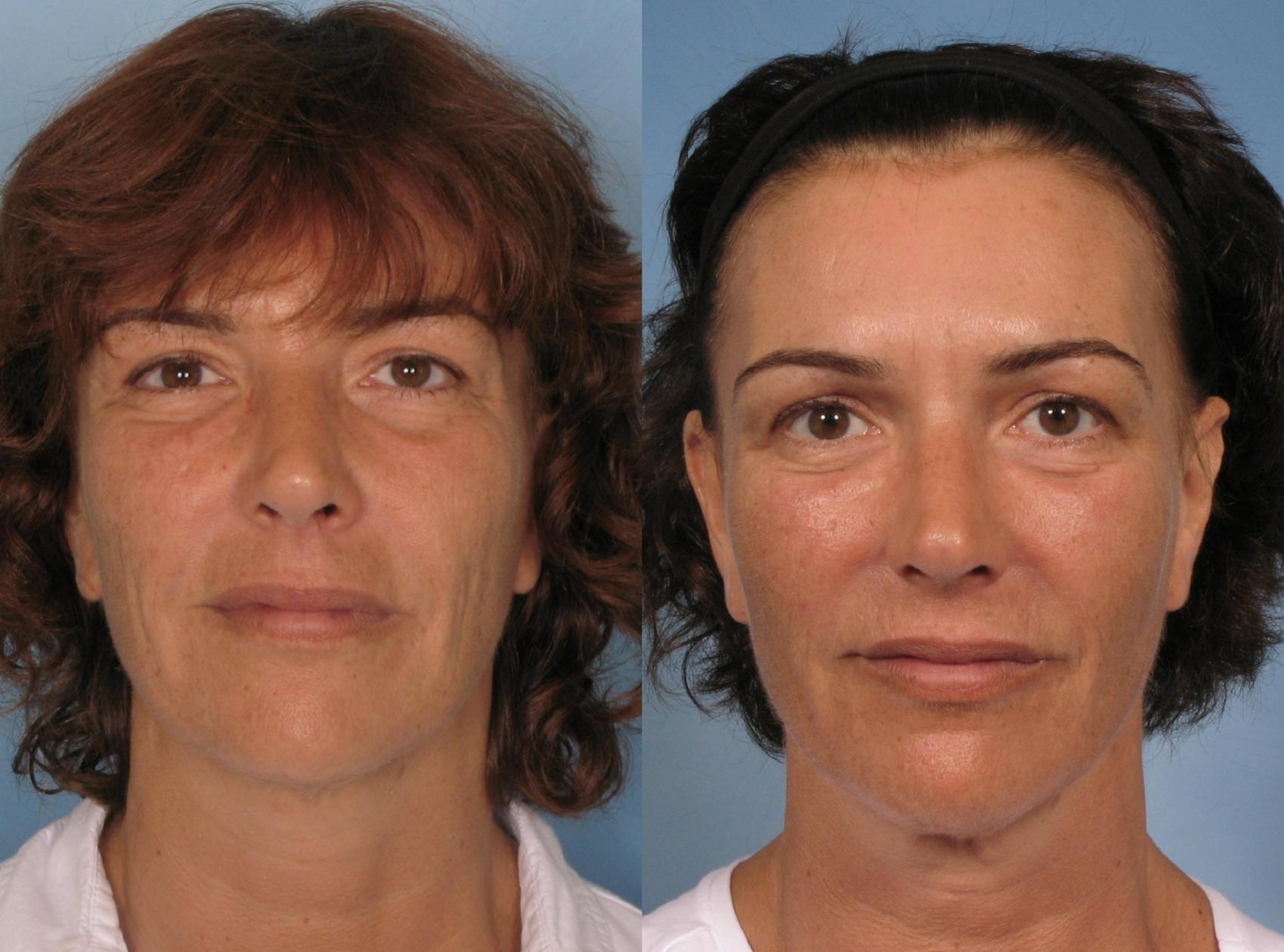 Before & After Sculptra® Case 126 View #1 View in Naples, FL