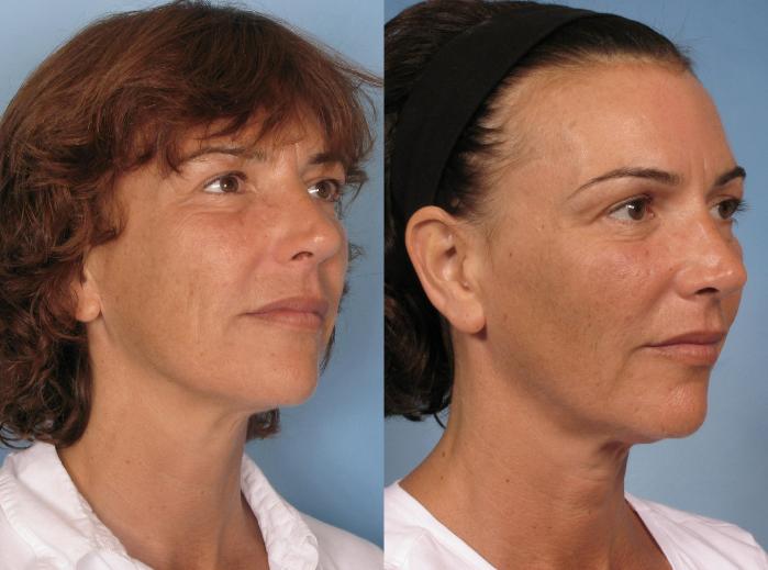 Before & After Sculptra® Case 126 View #2 View in Naples and Ft. Myers, FL