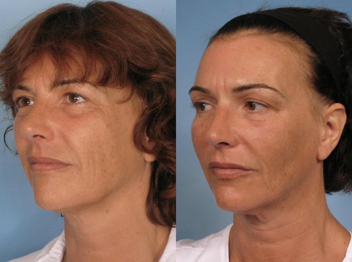 Before & After Sculptra® Case 126 View #3 View in Naples and Ft. Myers, FL