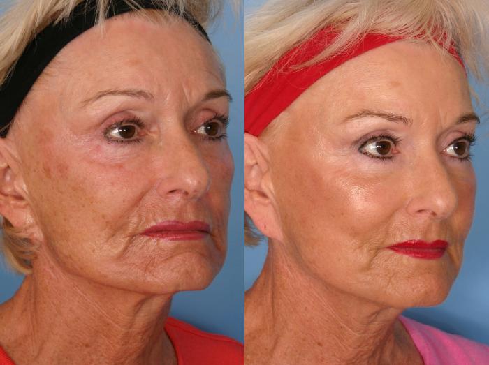 Before & After Sculptra® Case 64 View #2 View in Naples and Ft. Myers, FL