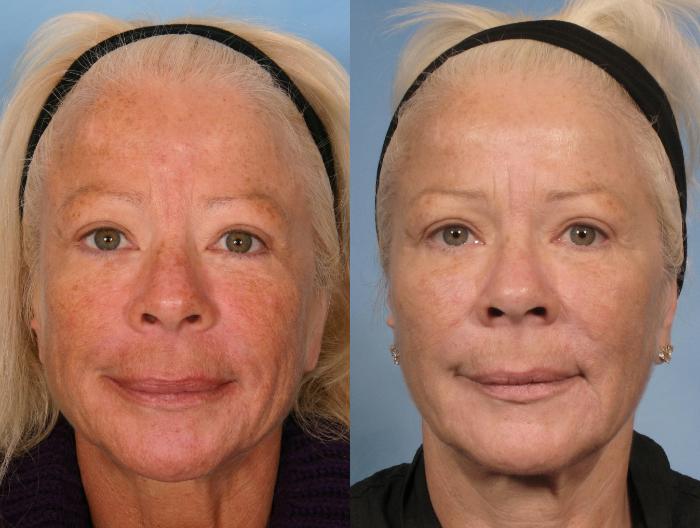 Before & After Sculptra® Case 84 View #3 View in Naples and Ft. Myers, FL