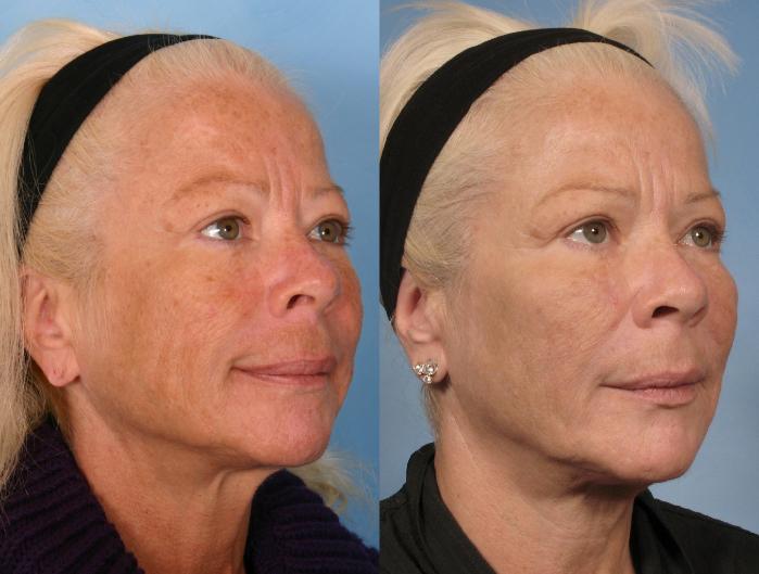 Before & After Sculptra® Case 84 View #4 View in Naples and Ft. Myers, FL