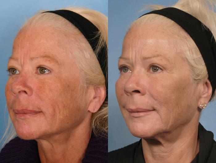 Before & After Sculptra® Case 84 View #5 View in Naples and Ft. Myers, FL