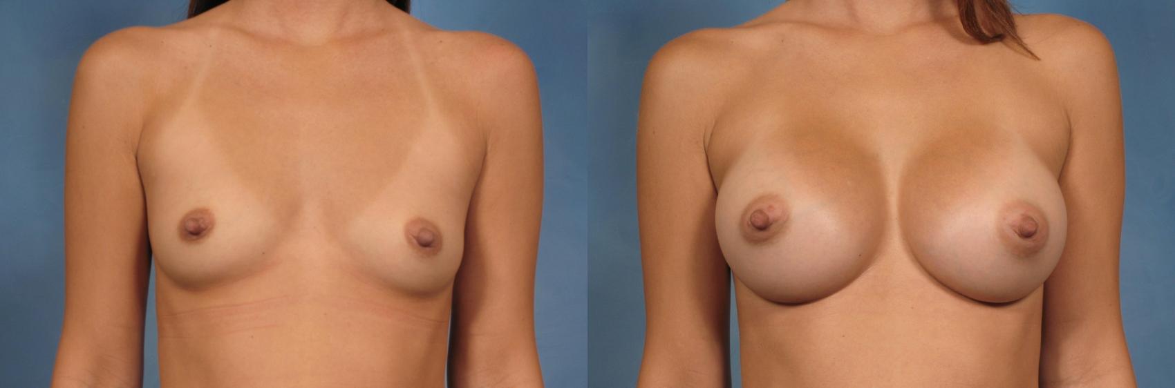 Before & After Silicone Breast Implants Case 105 View #2 View in Naples and Ft. Myers, FL