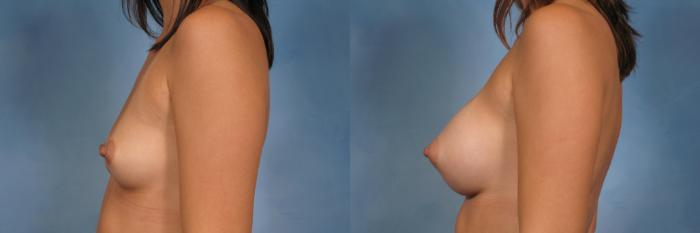 Before & After Silicone Breast Implants Case 105 View #5 View in Naples and Ft. Myers, FL