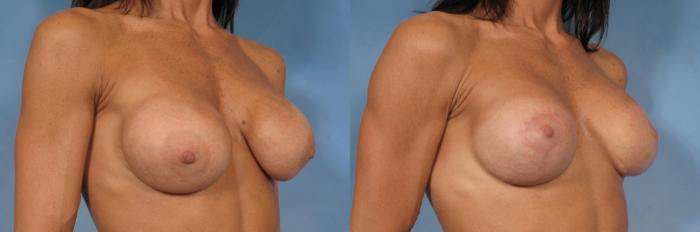 Before & After Silicone Breast Implants Case 120 View #3 View in Naples and Ft. Myers, FL