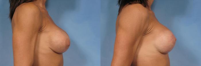 Before & After Silicone Breast Implants Case 120 View #4 View in Naples and Ft. Myers, FL