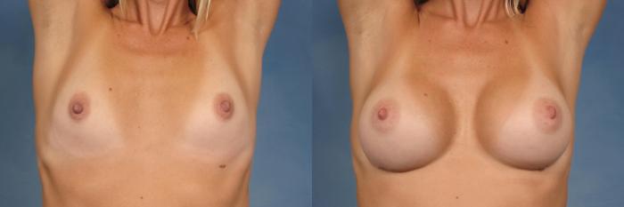 Before & After Silicone Breast Implants Case 122 View #2 View in Naples and Ft. Myers, FL