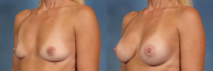 Before & After Silicone Breast Implants Case 122 View #4 View in Naples and Ft. Myers, FL