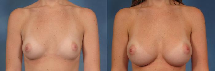 Before & After Silicone Breast Implants Case 143 View #1 View in Naples and Ft. Myers, FL