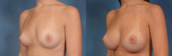 Before & After Silicone Breast Implants Case 143 View #2 View in Naples and Ft. Myers, FL