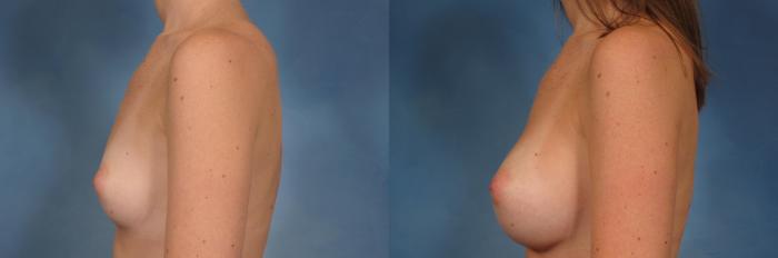 Before & After Silicone Breast Implants Case 143 View #3 View in Naples and Ft. Myers, FL