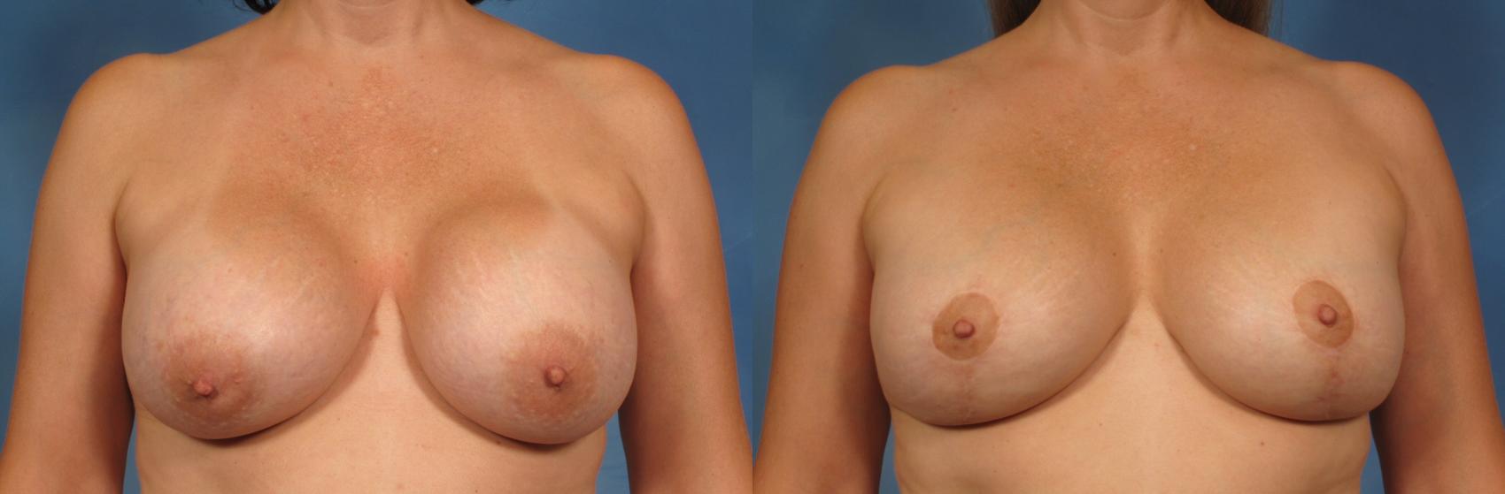 Before & After Silicone Breast Implants Case 149 View #1 View in Naples and Ft. Myers, FL