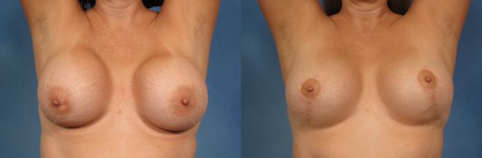 Before & After Silicone Breast Implants Case 149 View #2 View in Naples and Ft. Myers, FL