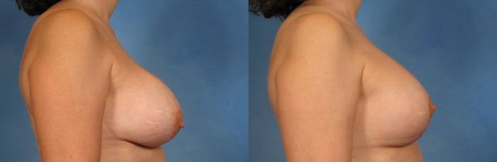 Before & After Silicone Breast Implants Case 149 View #3 View in Naples and Ft. Myers, FL
