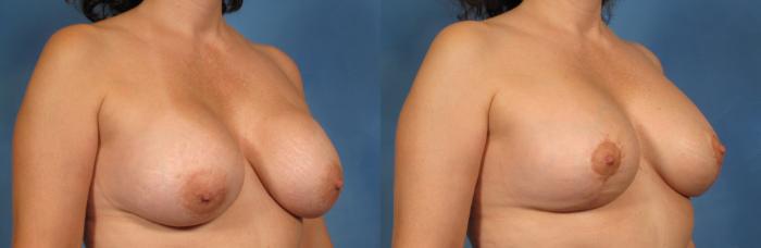 Before & After Silicone Breast Implants Case 149 View #4 View in Naples and Ft. Myers, FL