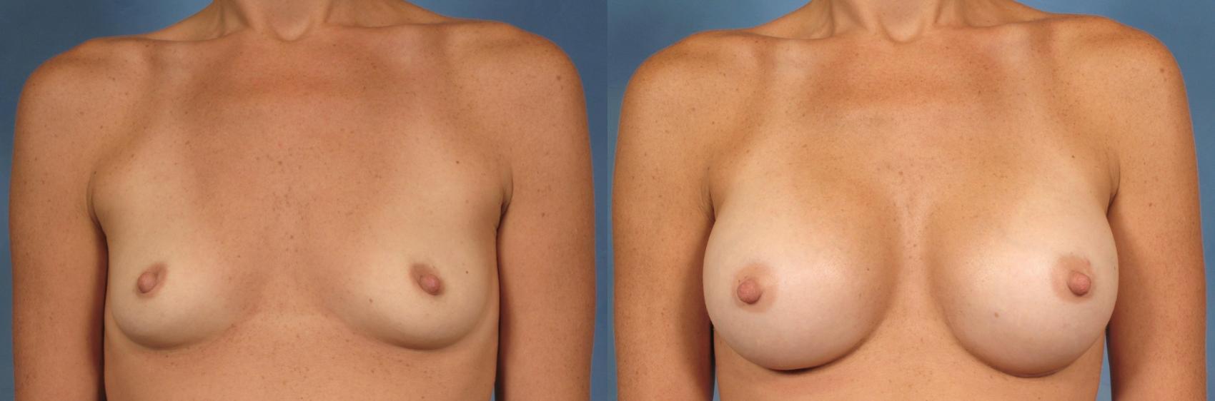 Before & After Silicone Breast Implants Case 156 View #1 View in Naples and Ft. Myers, FL
