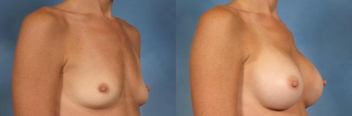 Before & After Silicone Breast Implants Case 156 View #2 View in Naples and Ft. Myers, FL