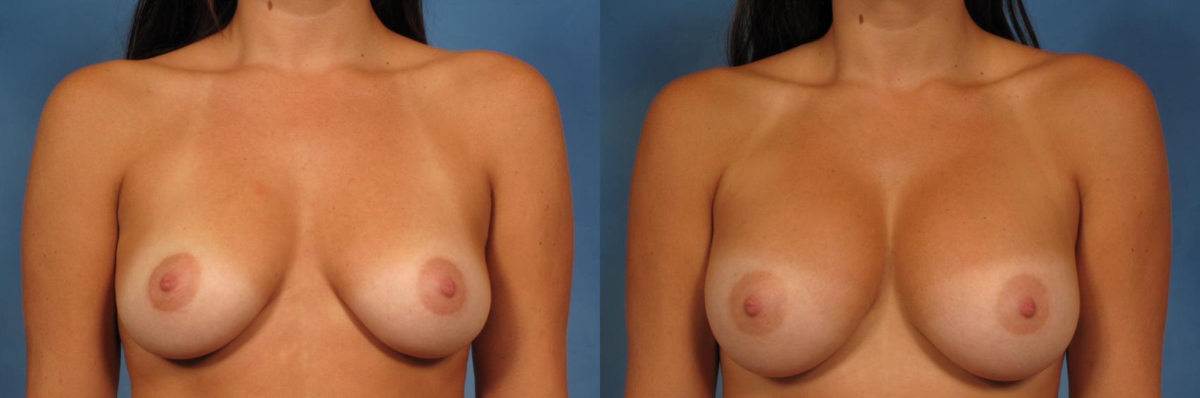 Before & After Silicone Breast Implants Case 161 View #4 View in Naples and Ft. Myers, FL