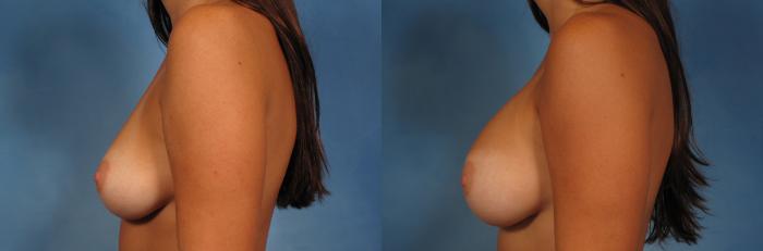Before & After Silicone Breast Implants Case 161 View #6 View in Naples and Ft. Myers, FL