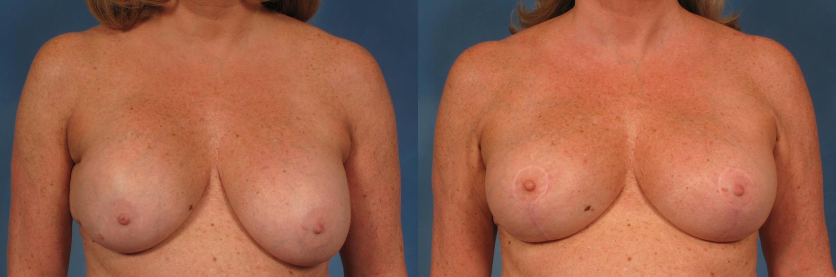 Before & After Silicone Breast Implants Case 202 View #1 View in Naples and Ft. Myers, FL