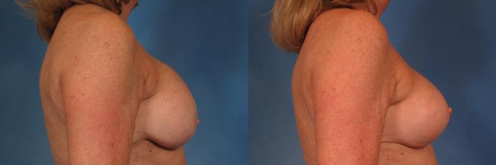 Before & After Silicone Breast Implants Case 202 View #2 View in Naples and Ft. Myers, FL