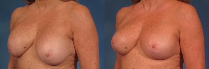 Before & After Silicone Breast Implants Case 202 View #3 View in Naples and Ft. Myers, FL