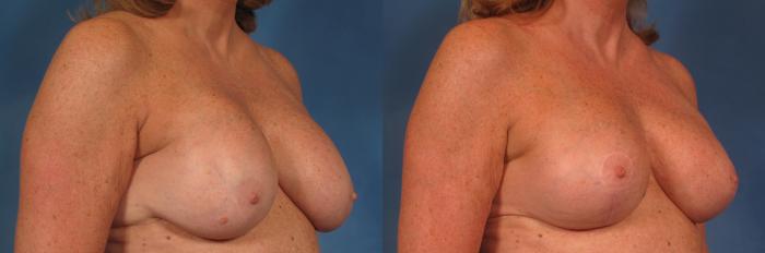 Before & After Silicone Breast Implants Case 202 View #4 View in Naples and Ft. Myers, FL