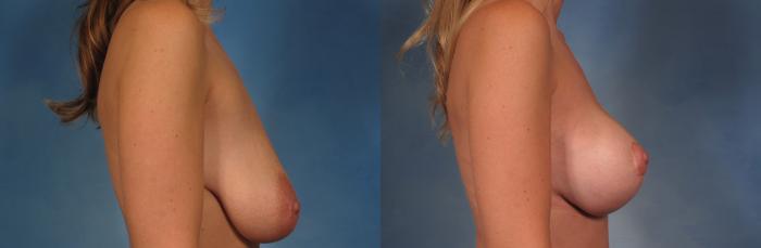 Before & After Silicone Breast Implants Case 204 View #2 View in Naples and Ft. Myers, FL