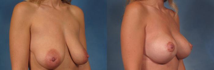 Before & After Silicone Breast Implants Case 204 View #3 View in Naples and Ft. Myers, FL