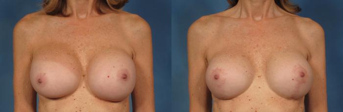 Before & After Silicone Breast Implants Case 230 View #1 View in Naples and Ft. Myers, FL