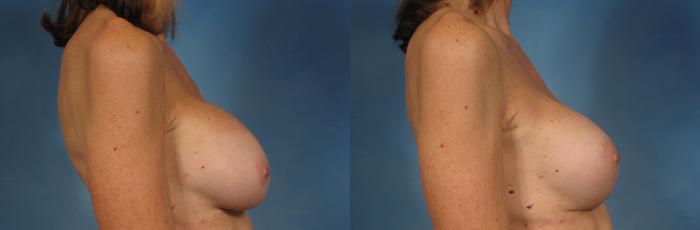 Before & After Silicone Breast Implants Case 230 View #2 View in Naples and Ft. Myers, FL