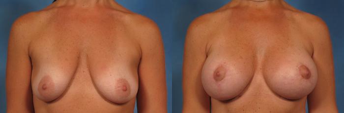 Before & After Silicone Breast Implants Case 231 View #1 View in Naples and Ft. Myers, FL