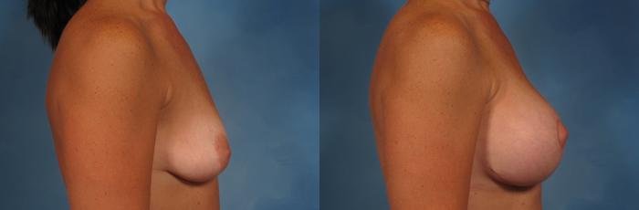 Before & After Silicone Breast Implants Case 231 View #2 View in Naples and Ft. Myers, FL