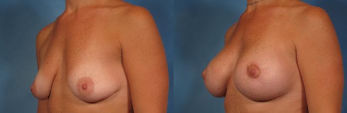 Before & After Silicone Breast Implants Case 231 View #3 View in Naples and Ft. Myers, FL