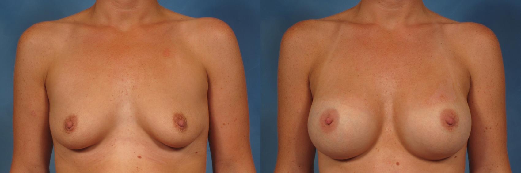 Before & After Silicone Breast Implants Case 251 View #1 View in Naples and Ft. Myers, FL