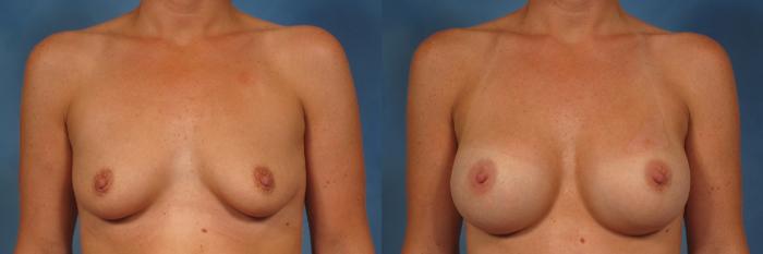 Before & After Silicone Breast Implants Case 251 View #1 View in Naples and Ft. Myers, FL