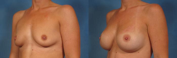 Before & After Silicone Breast Implants Case 251 View #2 View in Naples and Ft. Myers, FL