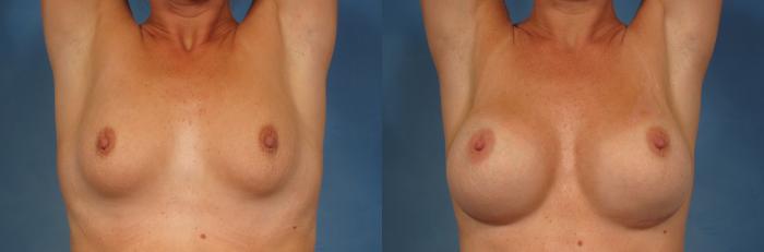 Before & After Silicone Breast Implants Case 251 View #4 View in Naples and Ft. Myers, FL