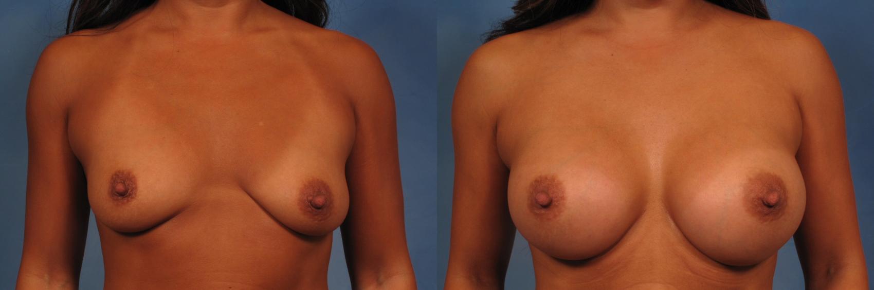 Before & After Silicone Breast Implants Case 271 View #1 View in Naples and Ft. Myers, FL