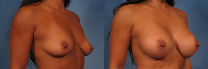 Before & After Silicone Breast Implants Case 271 View #2 View in Naples and Ft. Myers, FL