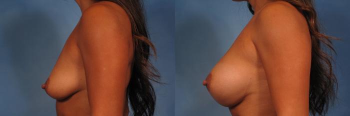 Before & After Silicone Breast Implants Case 271 View #3 View in Naples and Ft. Myers, FL