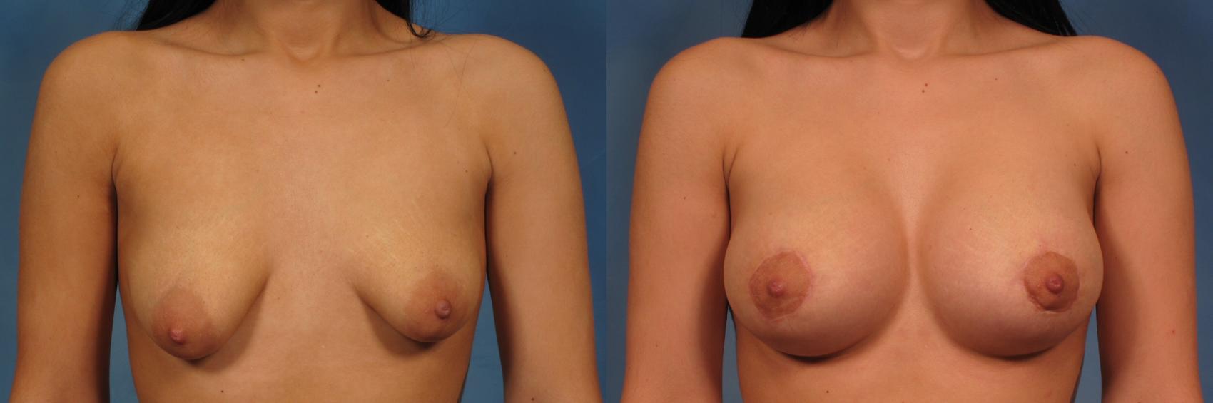 Before & After Silicone Breast Implants Case 273 View #1 View in Naples and Ft. Myers, FL
