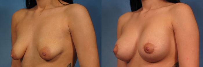 Before & After Silicone Breast Implants Case 273 View #2 View in Naples and Ft. Myers, FL
