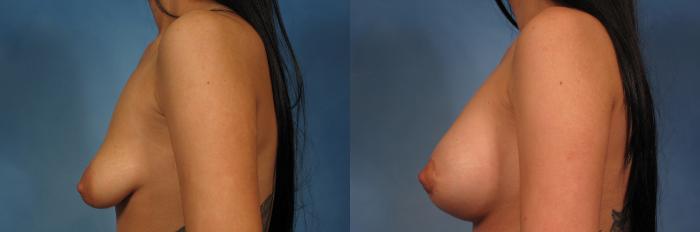Before & After Silicone Breast Implants Case 273 View #3 View in Naples and Ft. Myers, FL