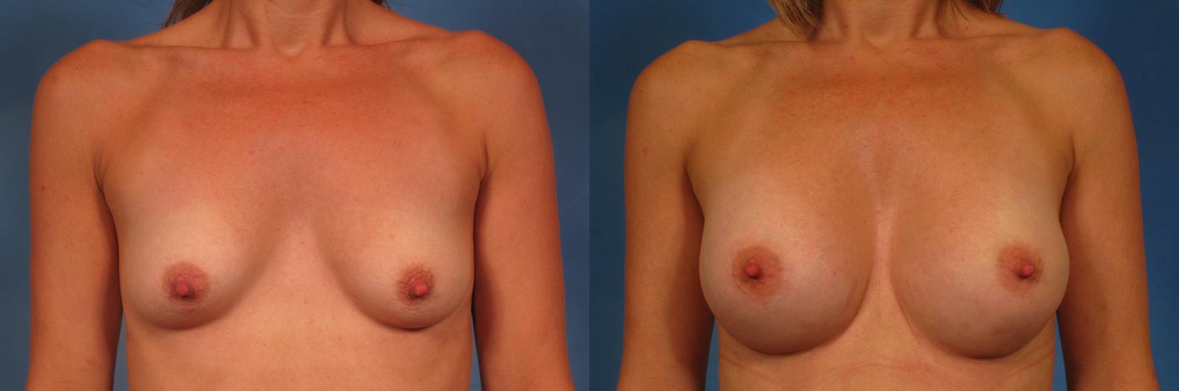 Before & After Silicone Breast Implants Case 279 View #1 View in Naples and Ft. Myers, FL